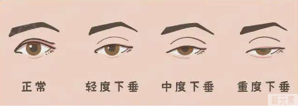 全国青少年上睑下垂矫正公益行启动，人民网、大众网、齐鲁网十余家为爱发声 图片-9