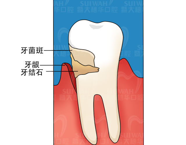 自测:判断一下，你的牙周是否还健康? 图片-4