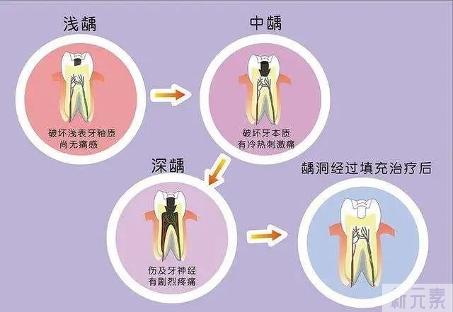科普来了 | 如何判断自己的蛀牙能直接补还是要做根管治疗? 图片-7
