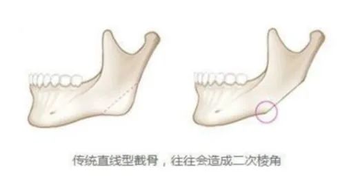 磨骨后一眼就能被识破?5个关于磨骨的误区，骗了多少人~ 图片-4