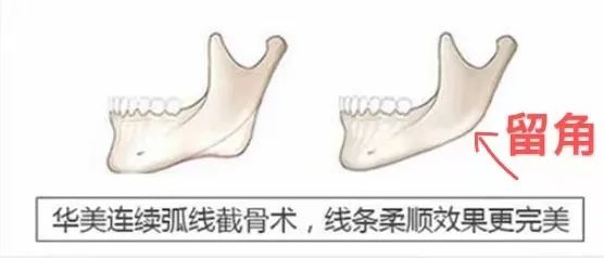 磨骨后一眼就能被识破?5个关于磨骨的误区，骗了多少人~ 图片-6