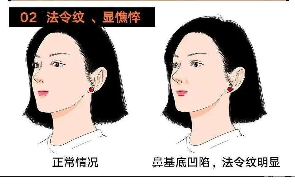 法令纹的分型，对症治疗 图片-7