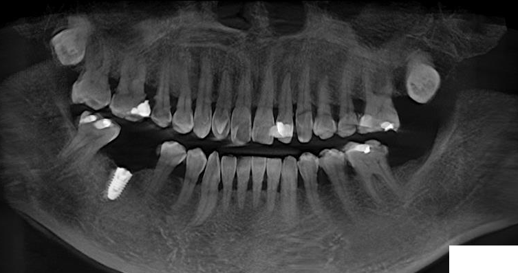 牙友:种牙到底需要多少个步骤? 图片-4