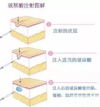 关于玻尿酸，你关心的都在这 图片-6