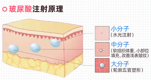 400元以内预算，选哪种玻尿酸好? 图片-24