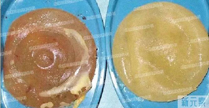 隆胸假体破裂知多少? 图片-4