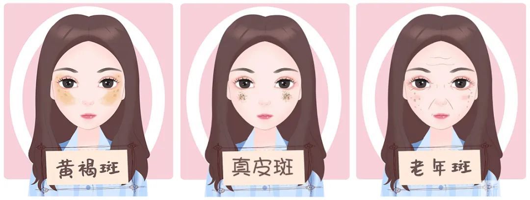 同样是激光祛斑，闺蜜皮肤白净，我却反黑成“大花脸”? 图片-4