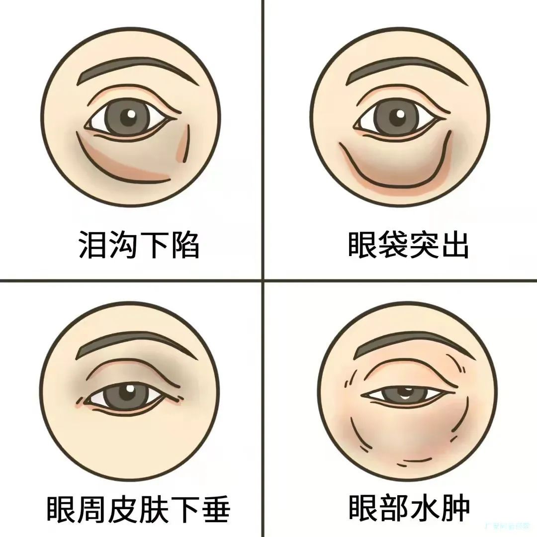 黑眼圈、不一定都是熬夜的锅 图片-3