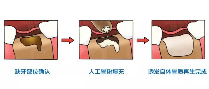 缺牙太久造成牙龈萎缩还可以做种植牙修复吗? 图片-12