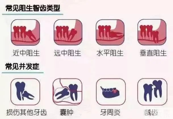 科普来了 | 拔智齿会导致牙齿松动吗? 图片-5