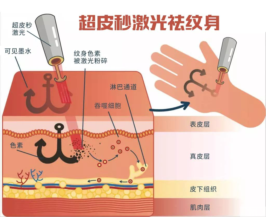 洗纹身丨不吹不黑，超皮秒真的更干净~ 图片-3