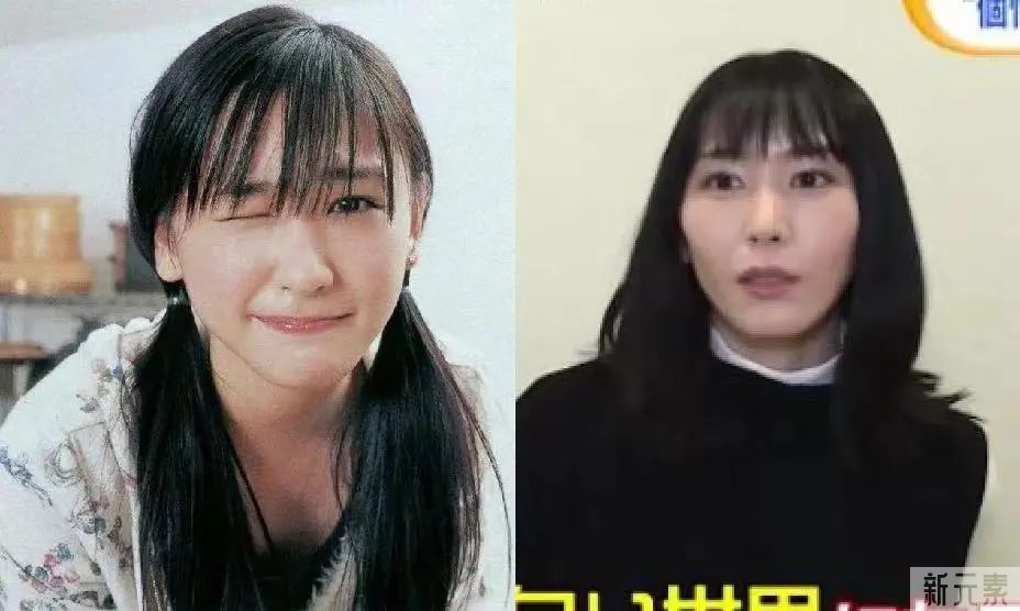 面部凹陷，只知道玻尿酸、脂肪填充?骨性填充了解一下! 图片-2
