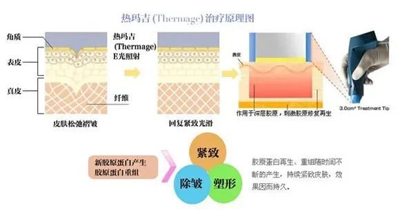 抗衰大盘点，热玛吉、fotona、热拉提优缺点分析! 图片-3