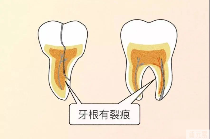 牙齿裂成蜘蛛网!却很难被发现吗? 图片-28