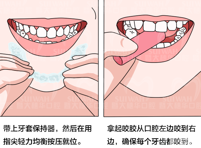 青少年正畸攻略 | 这份详细的矫牙流程，值得你收藏! 图片-14