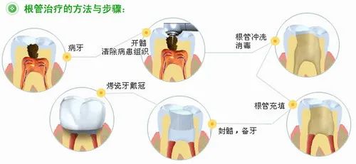 根管治疗后，牙齿可以“存活”多少年? 图片-3