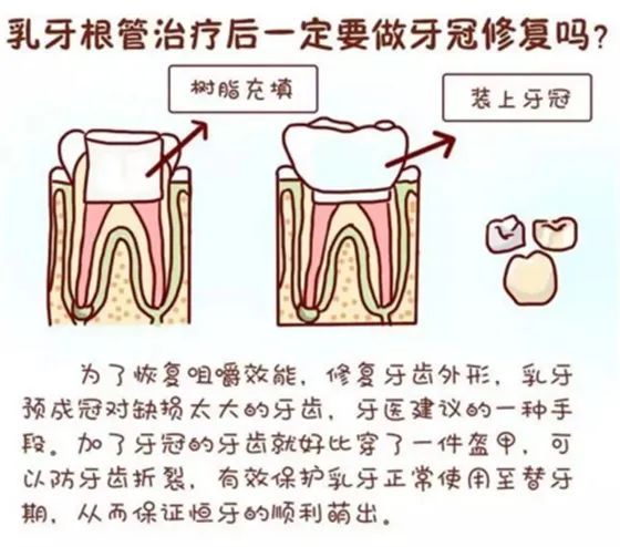 根管治疗后，牙齿可以“存活”多少年? 图片-6