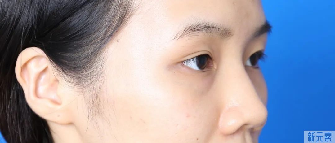 改善眼袋，绕不开这3种方法 图片-2