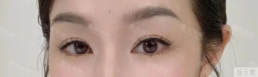 祛一次眼袋能不能管终身?医生说就看这2个关键点! 图片-8