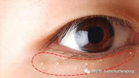 眼周脂肪粒——到底和眼霜有多大关系 图片-2