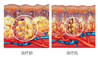 长期做三种光子嫩肤，皮肤会发生什么变化? 图片-26