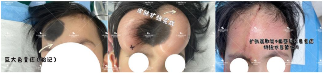 皮肤再造的福星“神奇水囊”，扩张器植入技术究竟是什么? 图片-9