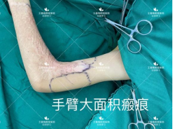 皮肤再造的福星“神奇水囊”，扩张器植入技术究竟是什么? 图片-11