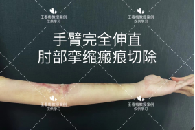 皮肤再造的福星“神奇水囊”，扩张器植入技术究竟是什么? 图片-14