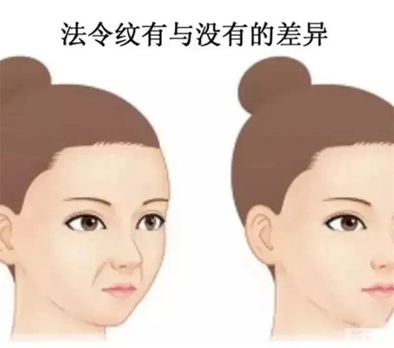 不同类型的法令纹，如何正确解决? 图片-1