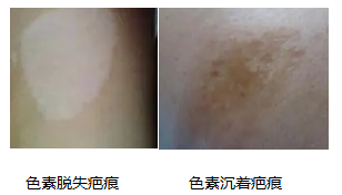 想要有效祛疤，这2步少不了! 图片-9