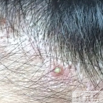 后脑勺长的小脓点，该怎么消掉? 图片-2