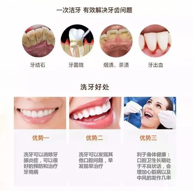 牙菌斑:细菌在口腔内开“派对”，你竟毫不知情! 图片-6