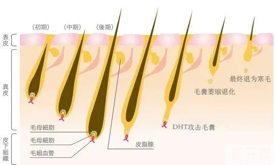 大部分脱发都从前额、头顶开始，原因是这样! 图片-4