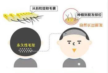 大部分脱发都从前额、头顶开始，原因是这样! 图片-5