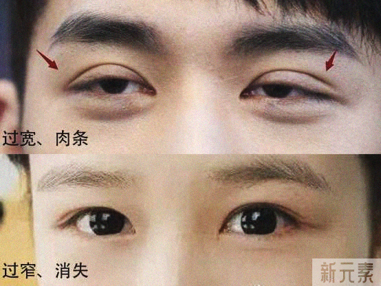 双眼皮失败的八种表现，你知道该如何应对吗? 图片-6