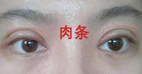 双眼皮失败的八种表现，你知道该如何应对吗? 图片-10