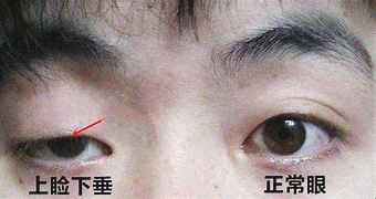 双眼皮失败的八种表现，你知道该如何应对吗? 图片-11