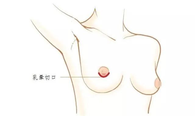 科普帖| 假体隆胸，选择哪种切口更好? 图片-11