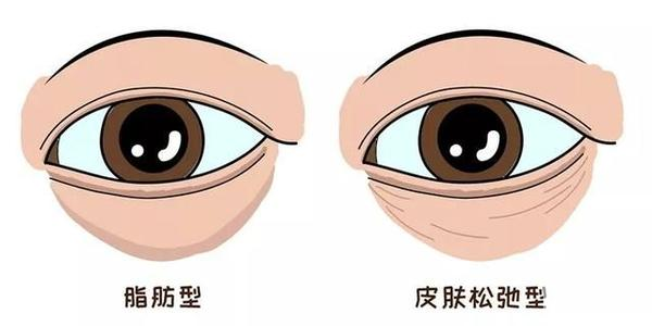 年轻人和中年人祛眼袋区别这么大?看完省了不少钱! 图片-5