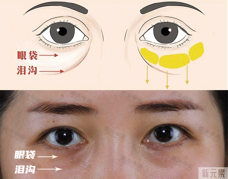 年轻人和中年人祛眼袋区别这么大?看完省了不少钱! 图片-3