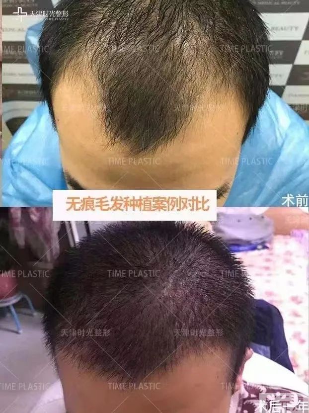 脱发人群需要移植多少个毛囊? 图片-3
