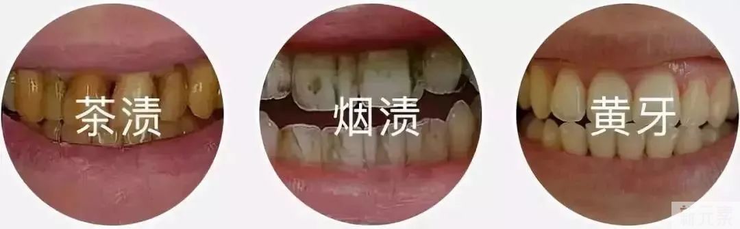 牙齿为什么会变黄?这个小妙招让你牙齿白白~ 图片-3