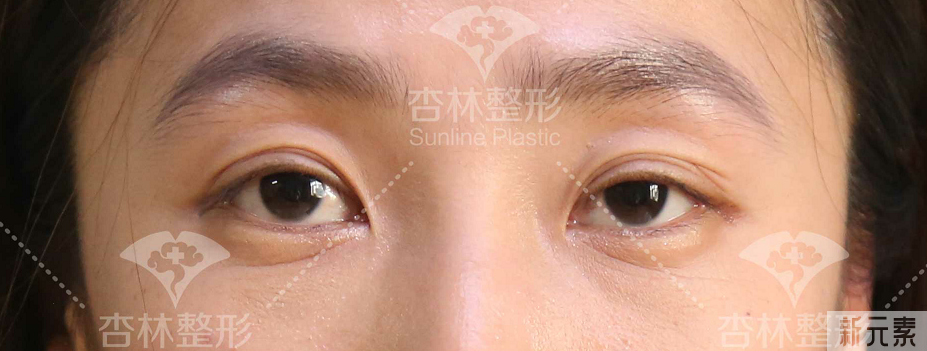 双眼皮真的越宽越好吗? 图片-11