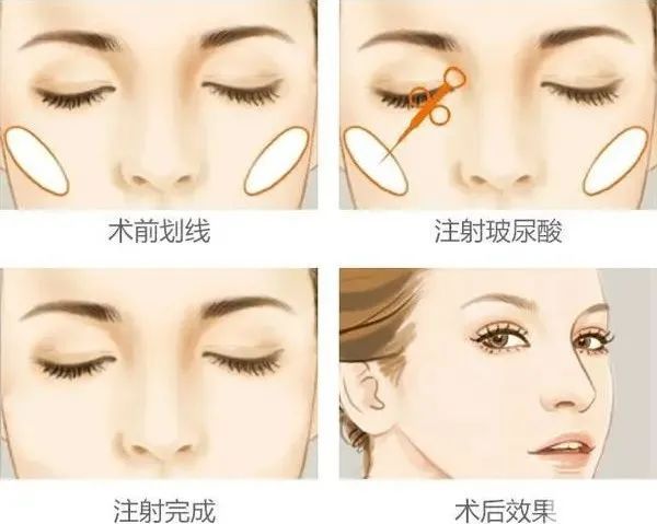 你对苹果肌的误解，都在这里了! 图片-7