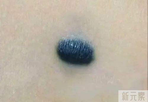 “黑痣”、“红痣”都见过，“蓝痣”您了解吗? 图片-13