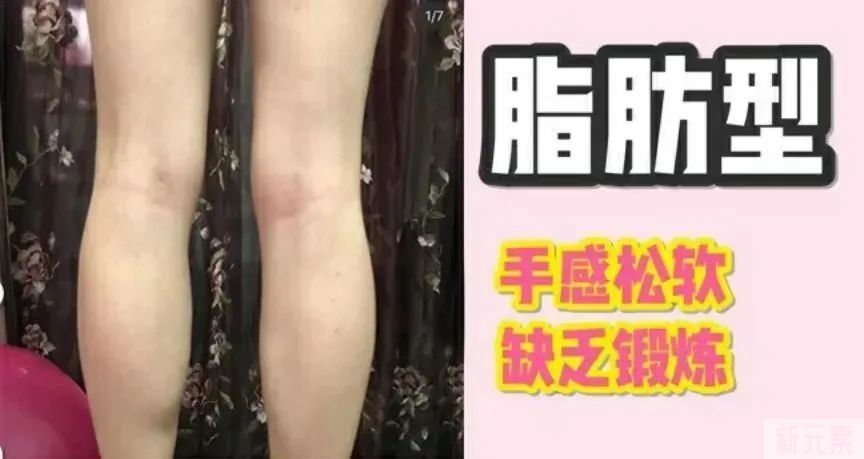 抽脂还是注射?选择你的瘦腿方案 图片-3