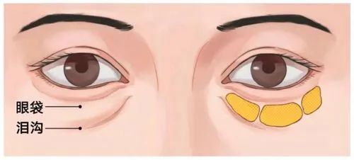 眼部问题，哪个杀伤力更强? 图片-6