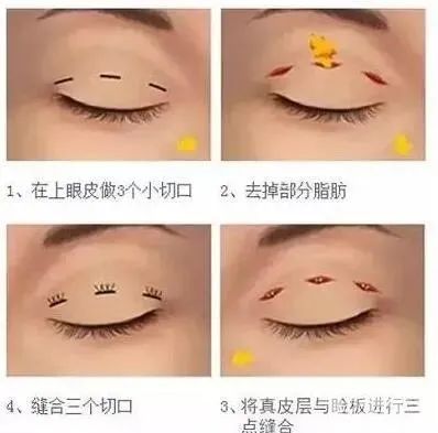 暑期想做双眼皮又担心“一眼假”?快收下这份避坑指南! 图片-8