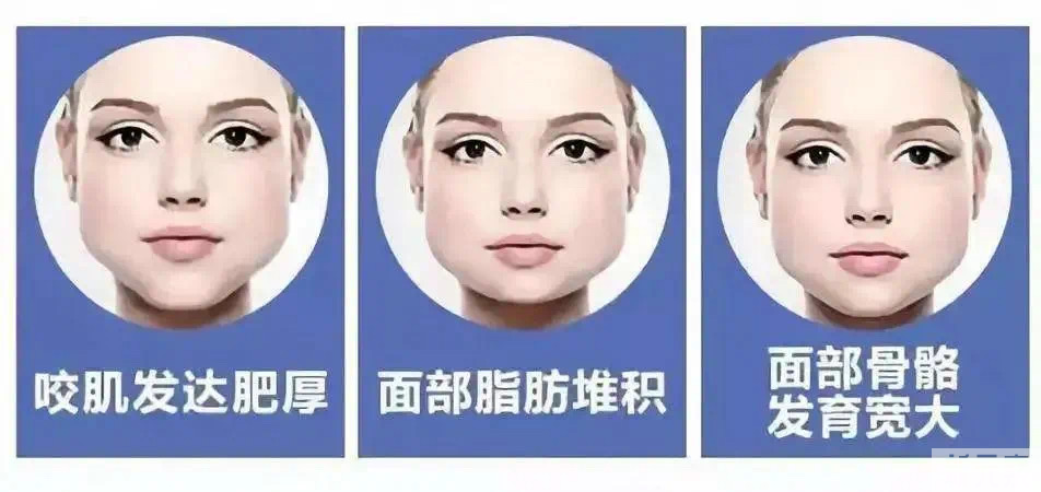 不是所有脸大 都适合打瘦脸..... 图片-2
