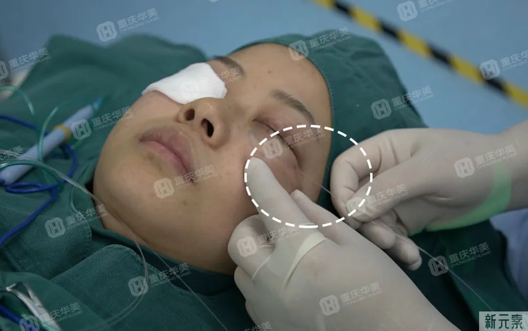 讲真!做祛眼袋手术时，千万不能省这个钱 图片-9